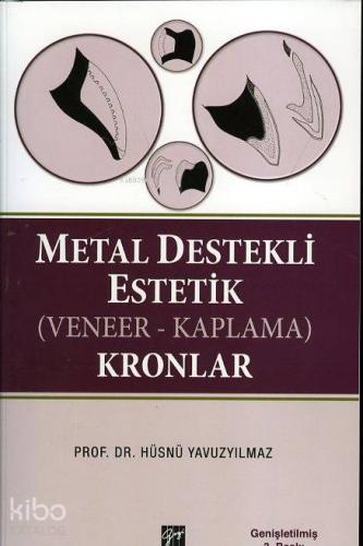 Metal Destekli Estetik Veneer Kaplama Kronlar